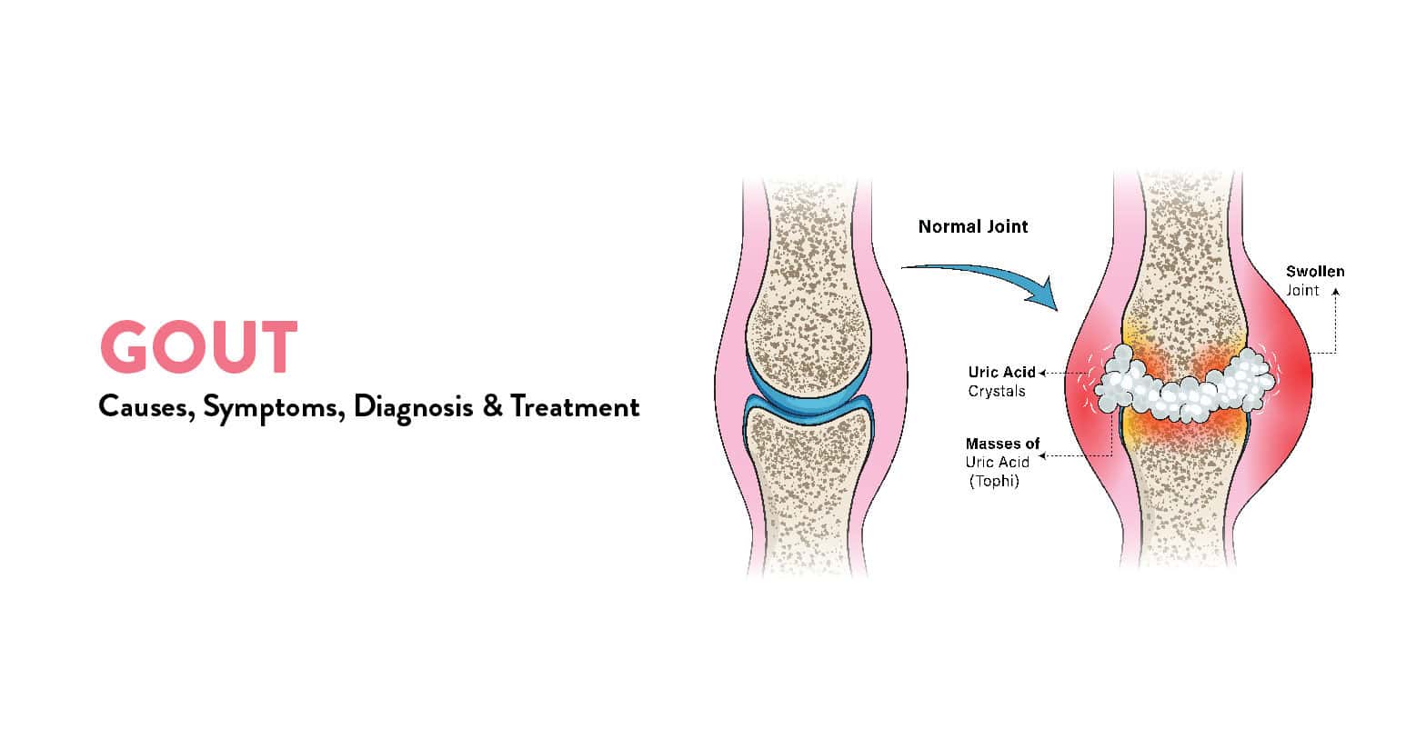 Gout Disease