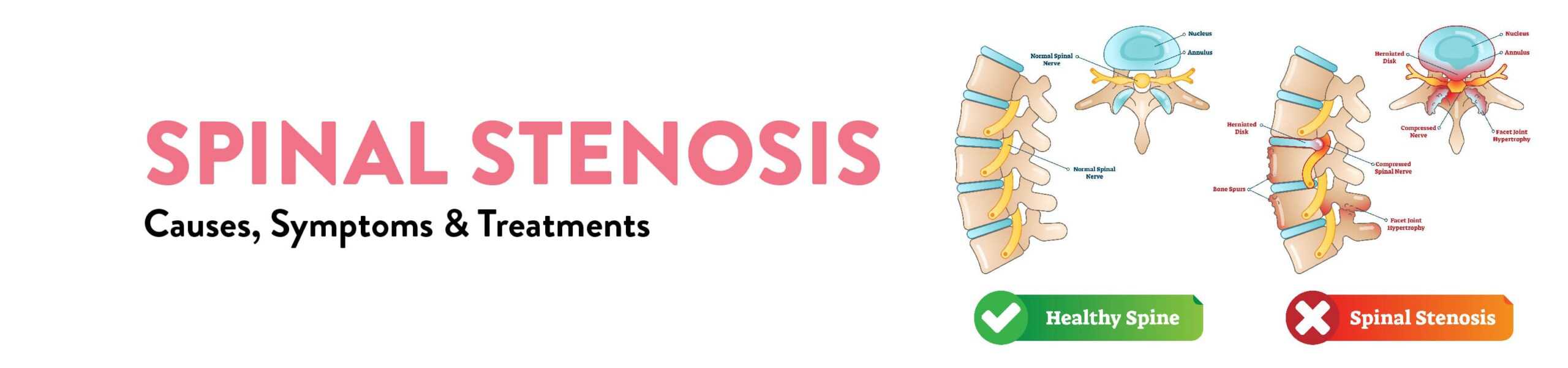 Spinal Stenosis