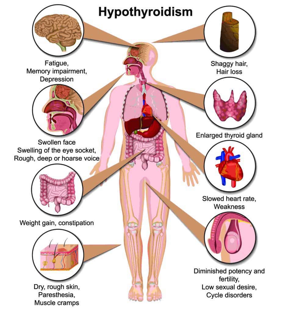 Hypothyroidism symptoms