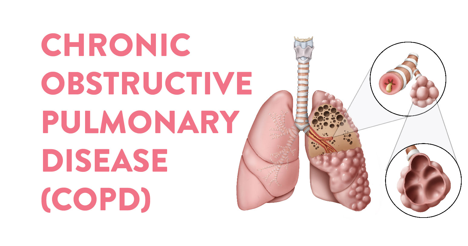 All you need to know about COPD disease Thumbnail Image