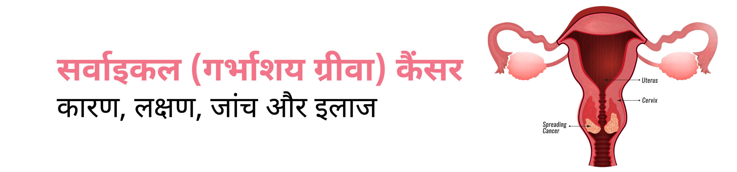 सर्वाइकल (गर्भाशय ग्रीवा) कैंसर- Cervical Cancer in Hindi