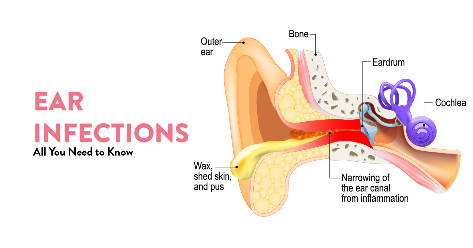 Ear Infections Thumbnail