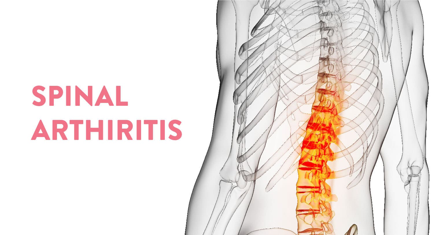 SPINAL ARTHIRITIS Thumbnail