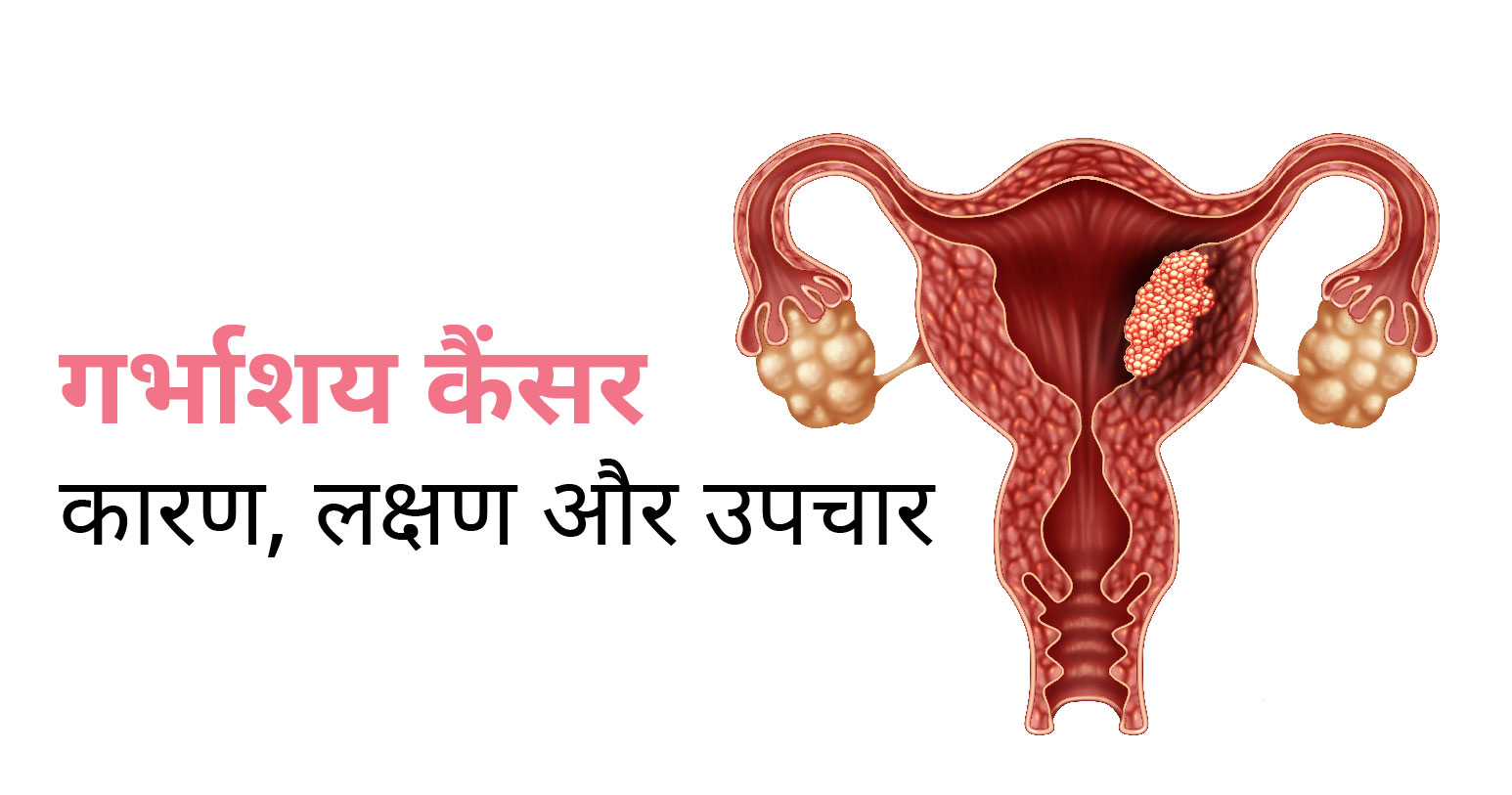 गर्भाशय कैंसर के कारण, लक्षण और उपचार Banner Image
