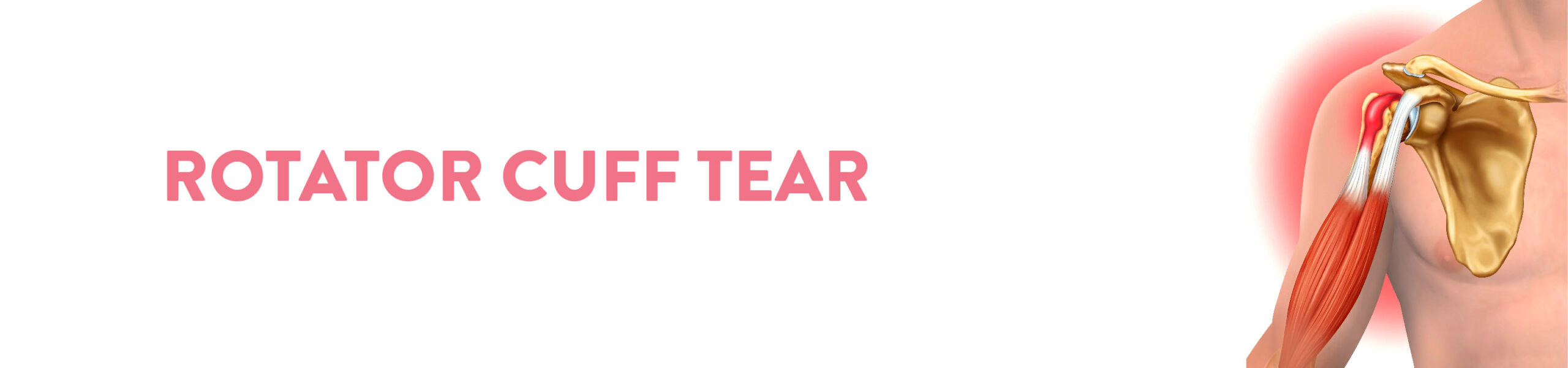 What is a rotator cuff tear?