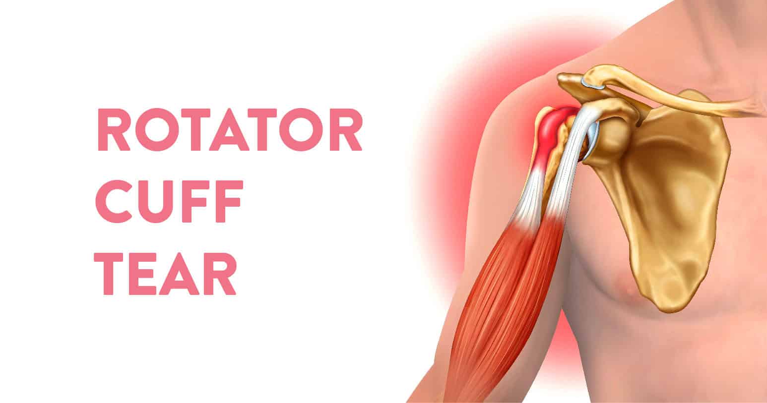 What is a rotator cuff tear?