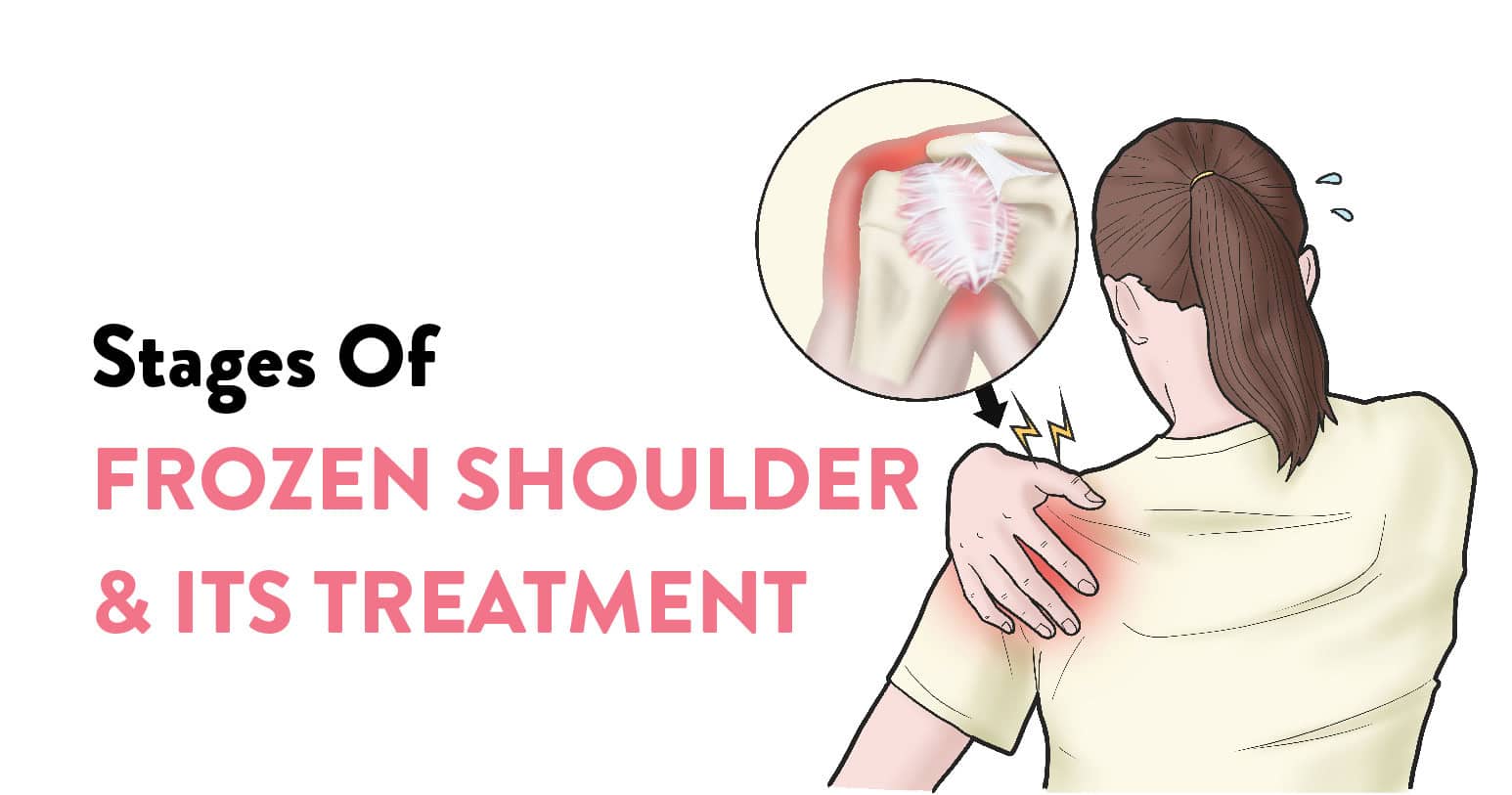 stages of frozen shoulder