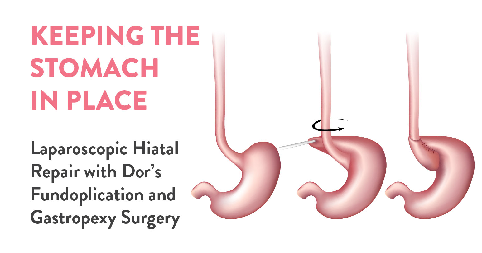 Laparoscopic Hiatal Repair with Dor’s Fundoplication and Gastropexy Surgery