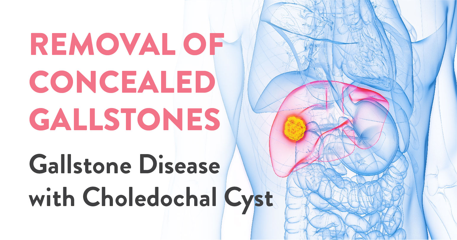 Successful removal of Concealed Gallstones By best GI & Bariatric Surgeons