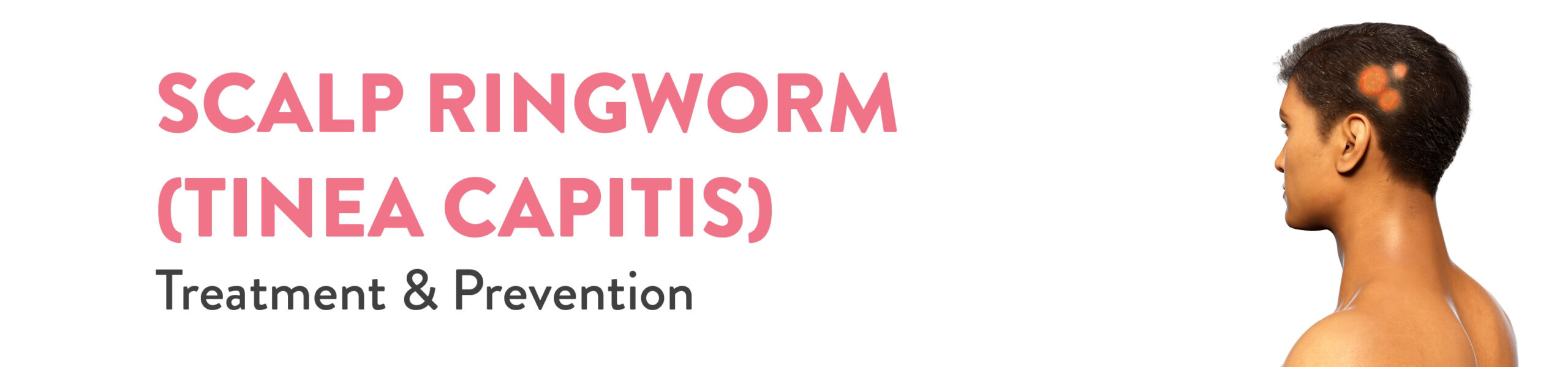 Scalp Ringworm Tinea Capitis Treatment & Prevention