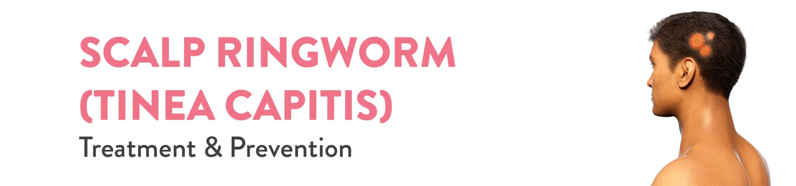 Ringworm Treatment Market Size, Share Report, 2032