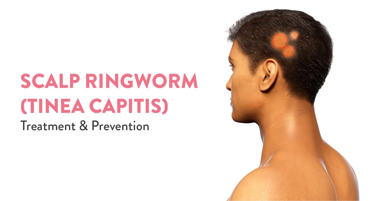 Scalp Ringworm Tinea Capitis Treatment & Prevention