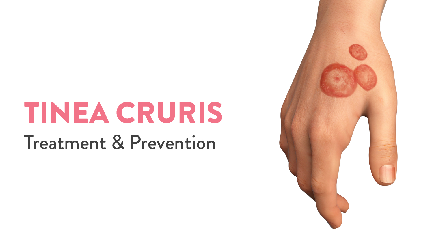 Tinea Cruris Treatment & Prevention