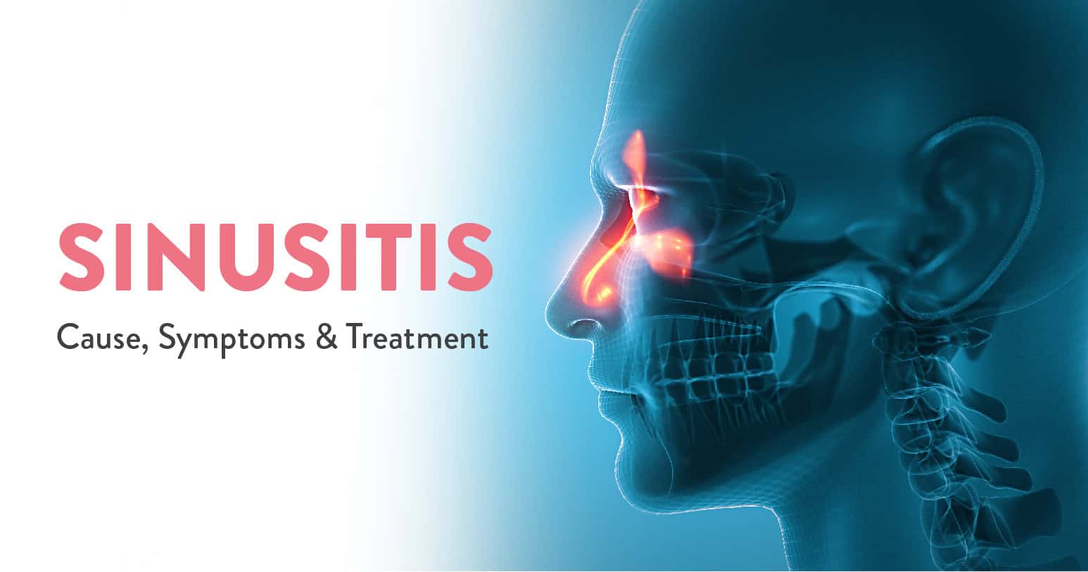 Sinusitis