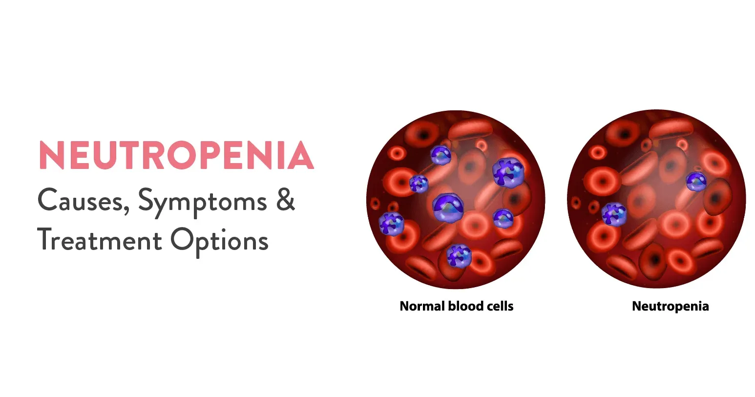 Neutropenia causes