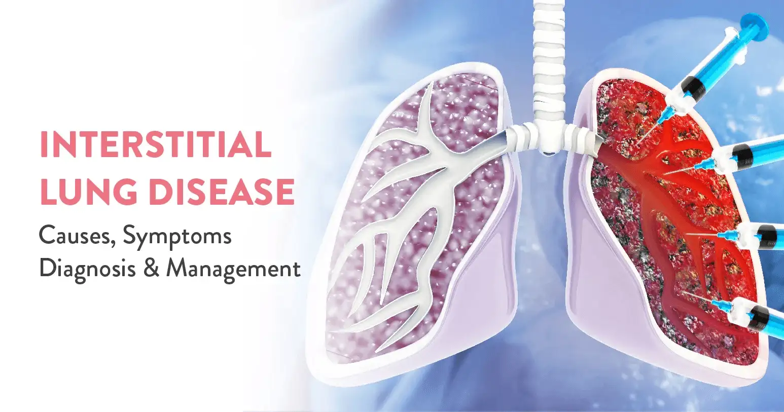 What is Interstitial Lung Disease