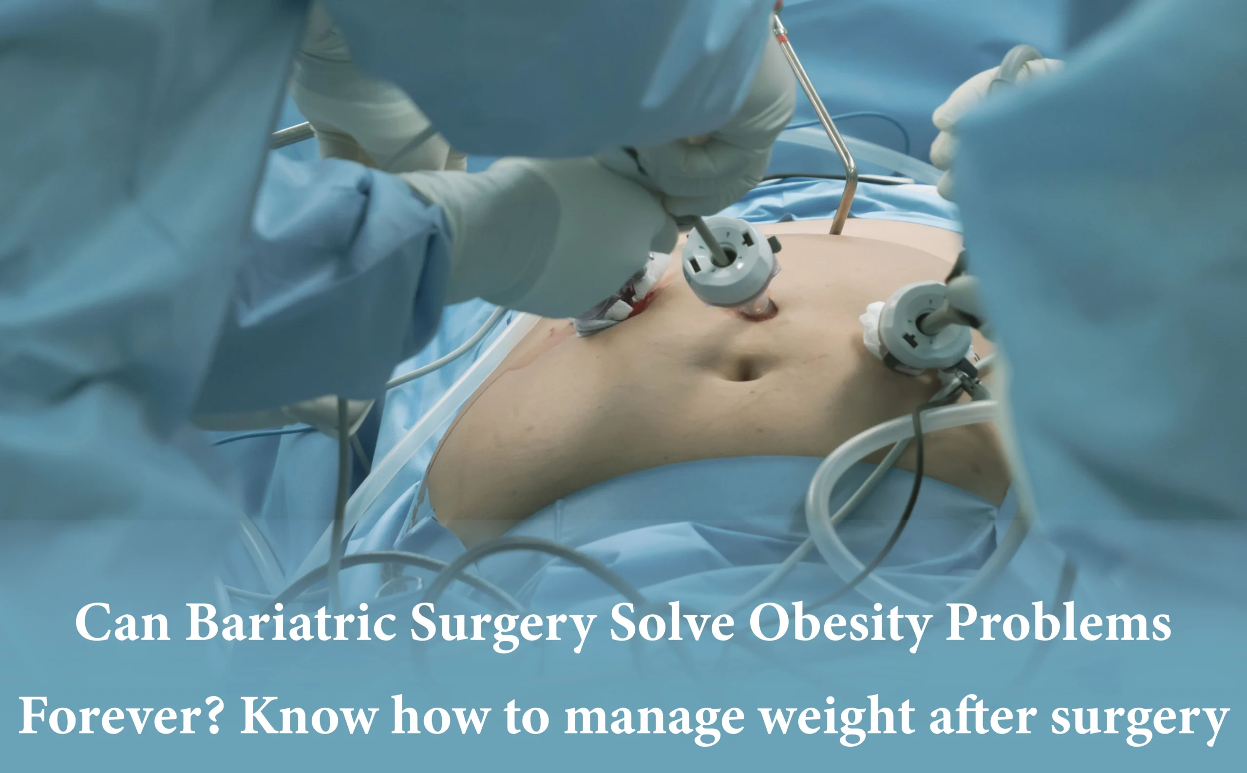 Can Bariatric Surgery Solve Obesity Problems Forever? Know How to Manage Weight After Surgery