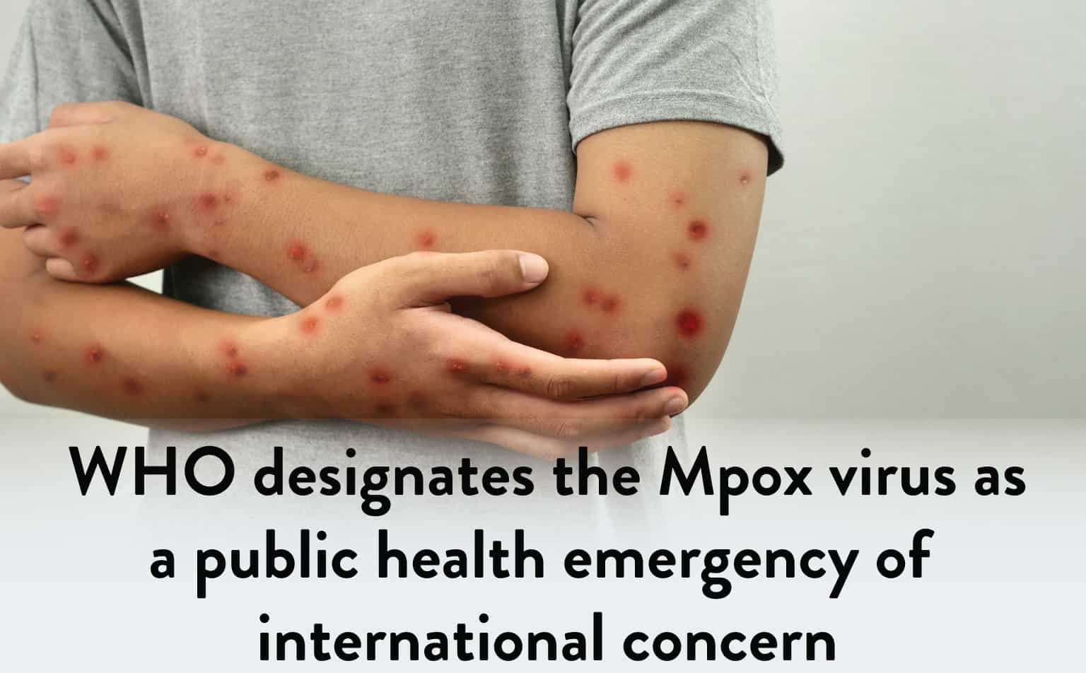 WHO designating the Mpox virus as a public health emergency of international concern