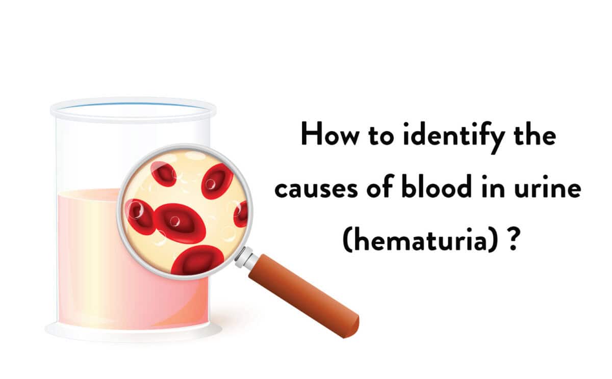 How-to-identify-the-causes-of-blood-in-urine-hematuria