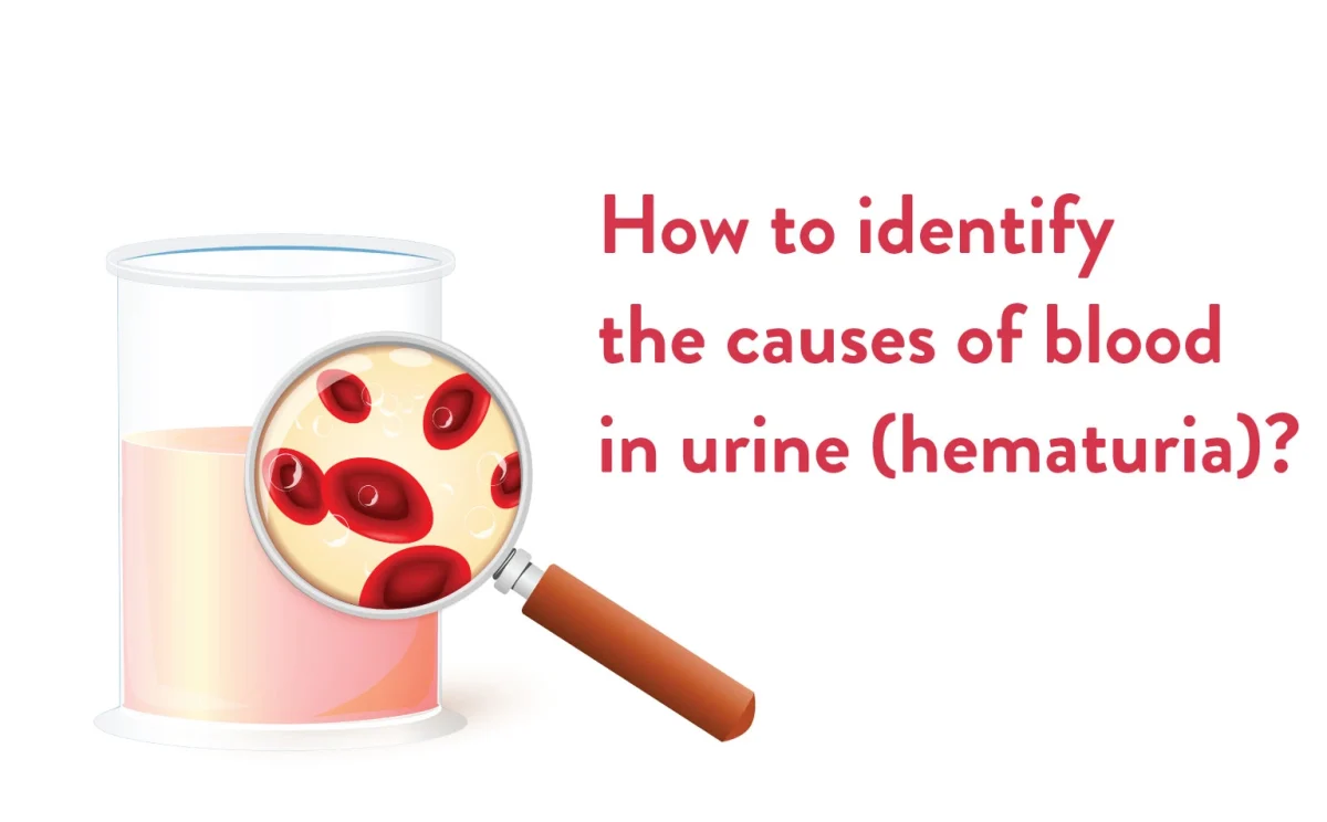 Identifying the cause of blood in urine (hematuria)